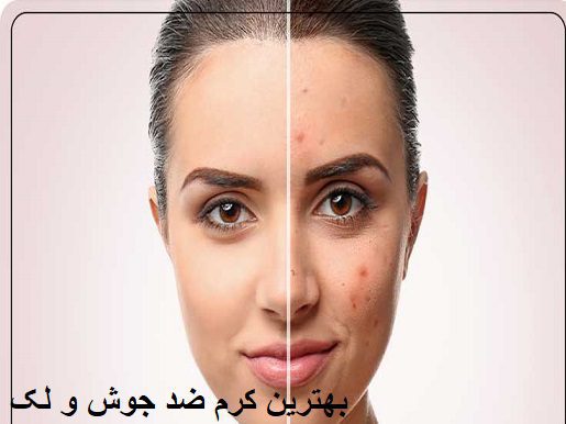 بهترین کرم ضد جوش و لک 3 بهترین کرم ضد جوش و لک